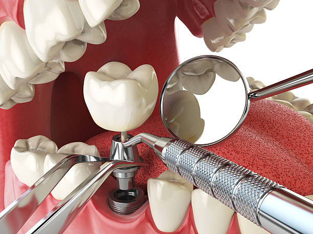 Best Emergency Broken Tooth Repair in Chelsea, MI